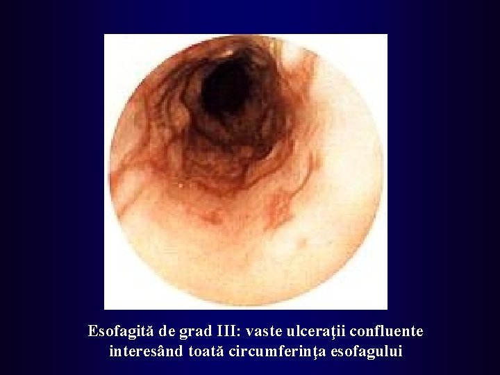 Esofagită de grad III: vaste ulceraţii confluente interesând toată circumferinţa esofagului 