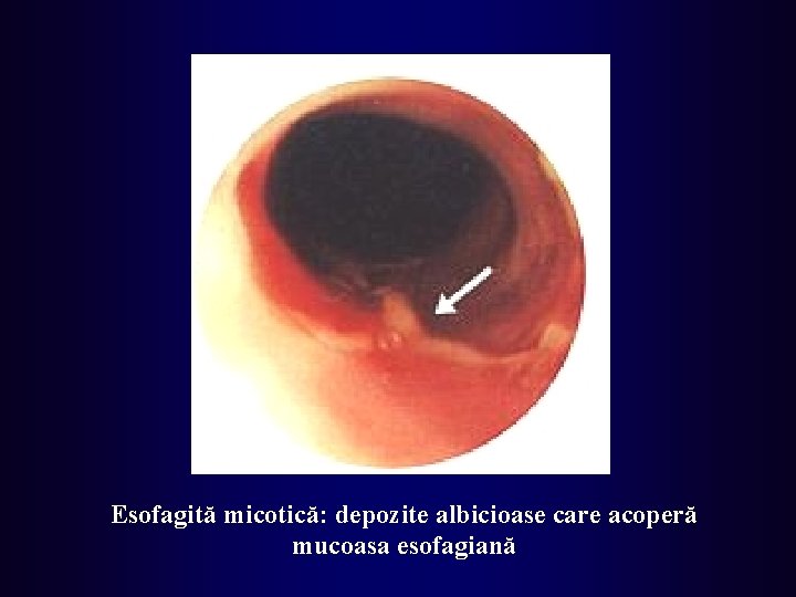 Esofagită micotică: depozite albicioase care acoperă mucoasa esofagiană 
