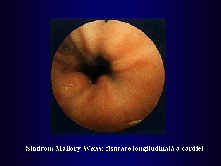 Sindrom Mallory-Weiss: fisurare longitudinală a cardiei 