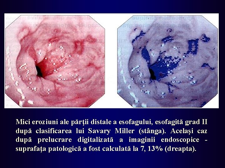 Mici eroziuni ale părţii distale a esofagului, esofagită grad II după clasificarea lui Savary