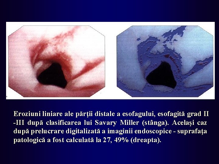 Eroziuni liniare ale părţii distale a esofagului, esofagită grad II -III după clasificarea lui