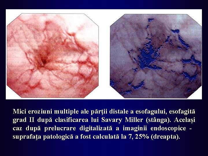 Mici eroziuni multiple ale părţii distale a esofagului, esofagită grad II după clasificarea lui