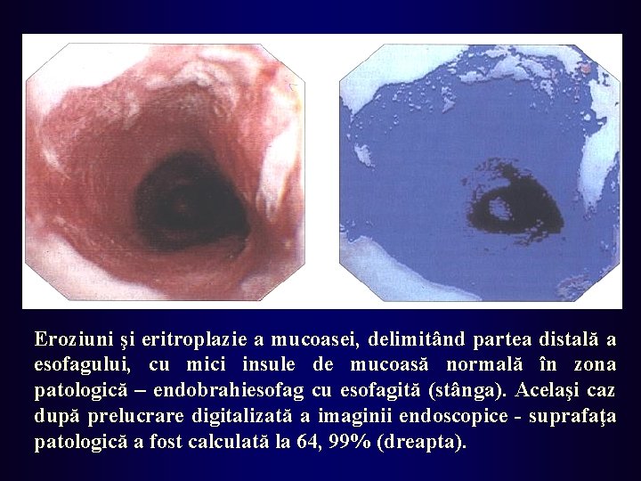 Eroziuni şi eritroplazie a mucoasei, delimitând partea distală a esofagului, cu mici insule de