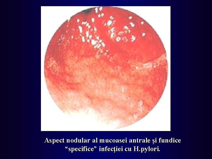 Aspect nodular al mucoasei antrale şi fundice “specifice” infecţiei cu H. pylori. 