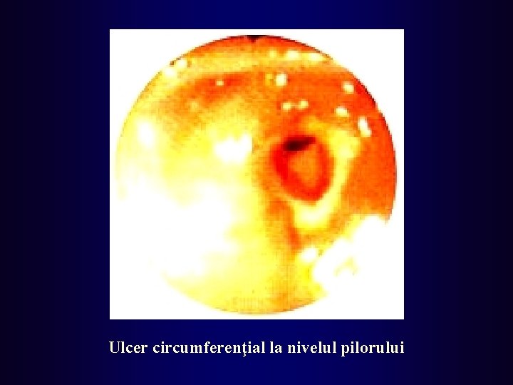 Ulcer circumferenţial la nivelul pilorului 