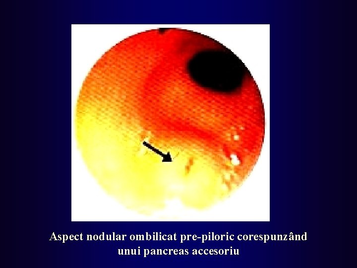 Aspect nodular ombilicat pre-piloric corespunzând unui pancreas accesoriu 