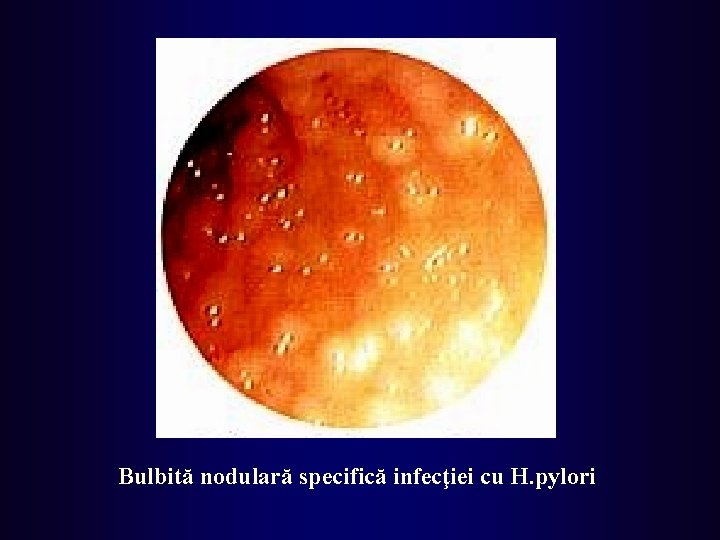 Bulbită nodulară specifică infecţiei cu H. pylori 