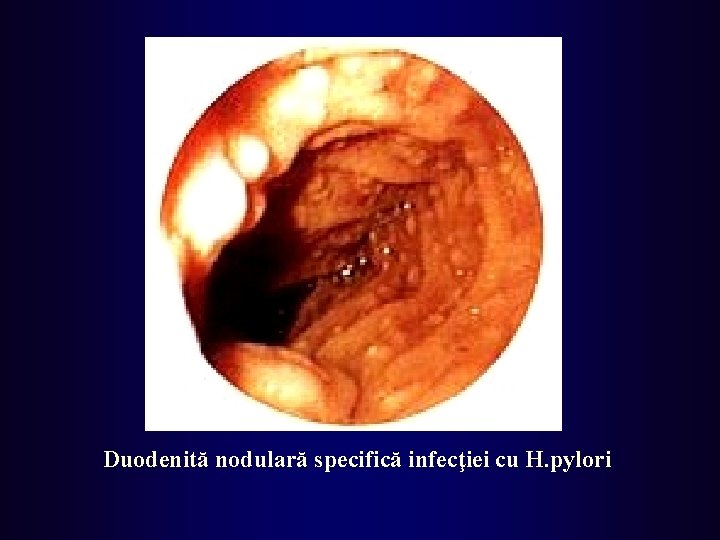 Duodenită nodulară specifică infecţiei cu H. pylori 