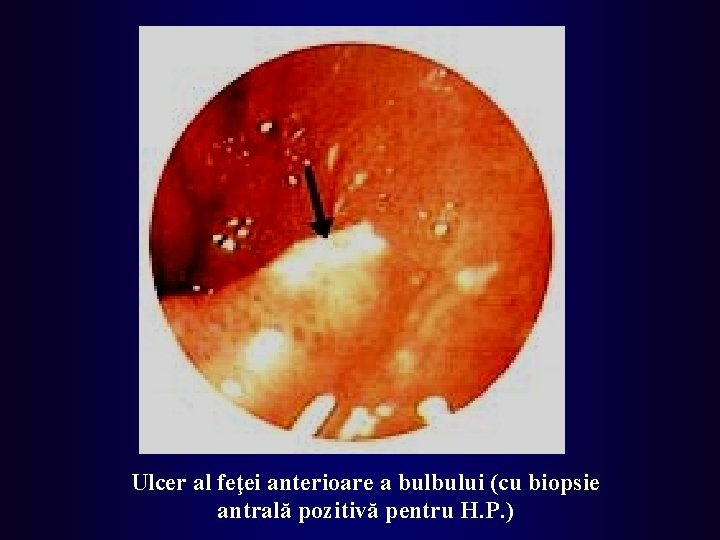 Ulcer al feţei anterioare a bulbului (cu biopsie antrală pozitivă pentru H. P. )