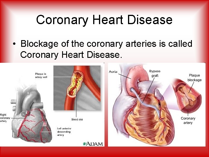 Coronary Heart Disease • Blockage of the coronary arteries is called Coronary Heart Disease.