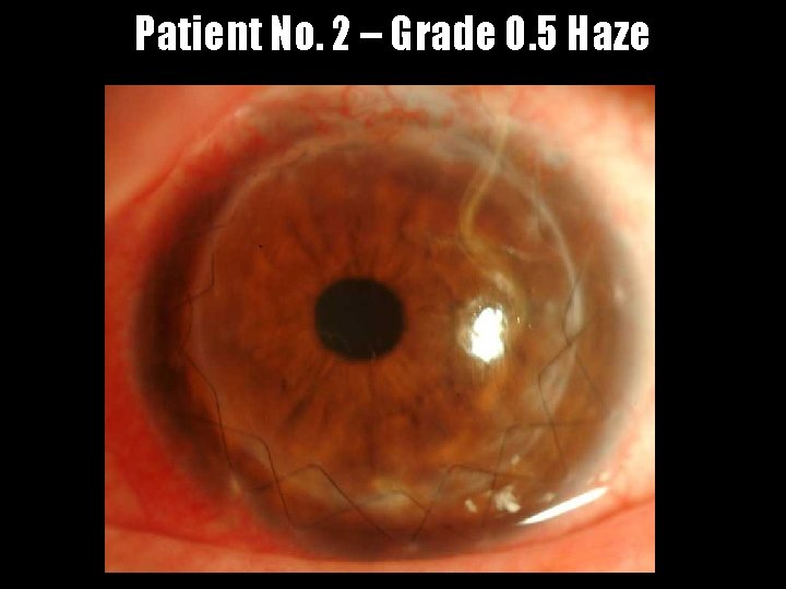 Patient No. 2 – Grade 0. 5 Haze 