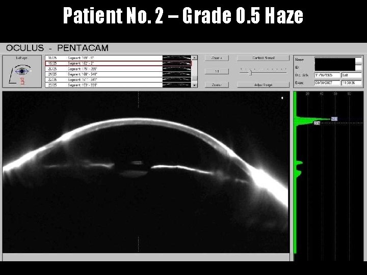 Patient No. 2 – Grade 0. 5 Haze 
