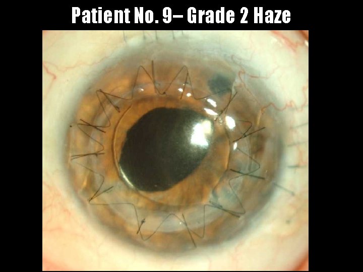 Patient No. 9– Grade 2 Haze 
