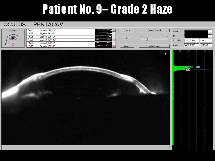 Patient No. 9– Grade 2 Haze 