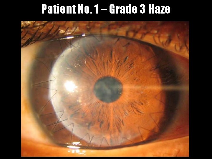 Patient No. 1 – Grade 3 Haze 