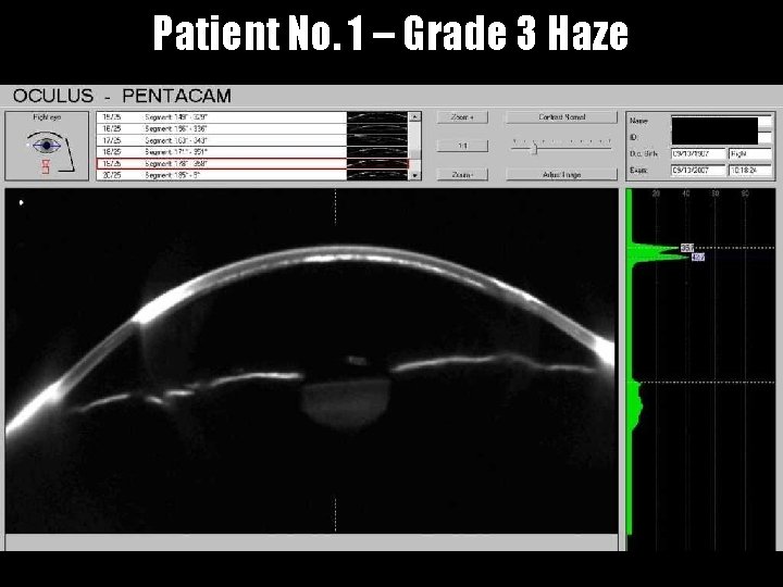 Patient No. 1 – Grade 3 Haze 