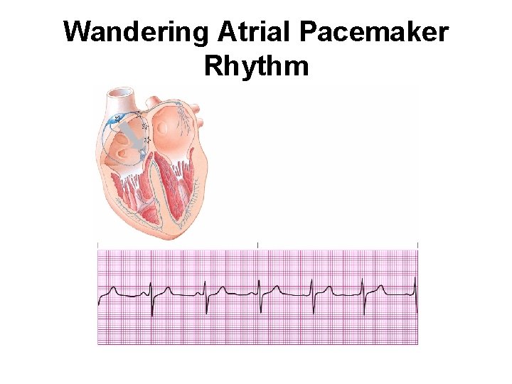 Wandering Atrial Pacemaker Rhythm 