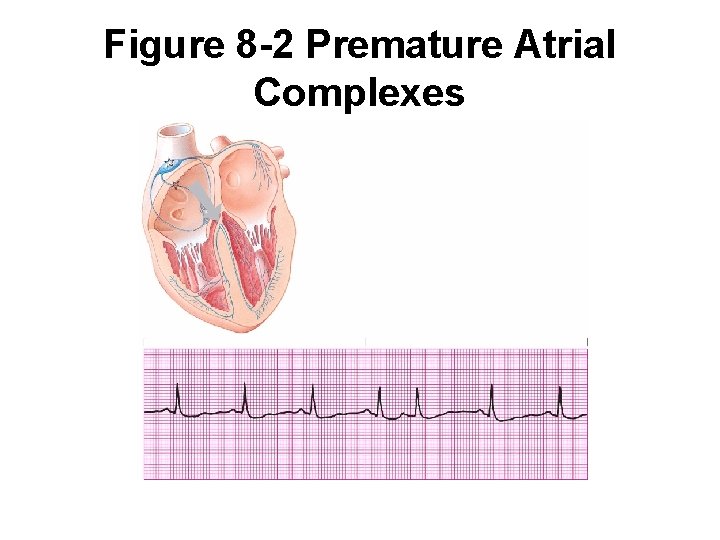 Figure 8 -2 Premature Atrial Complexes 