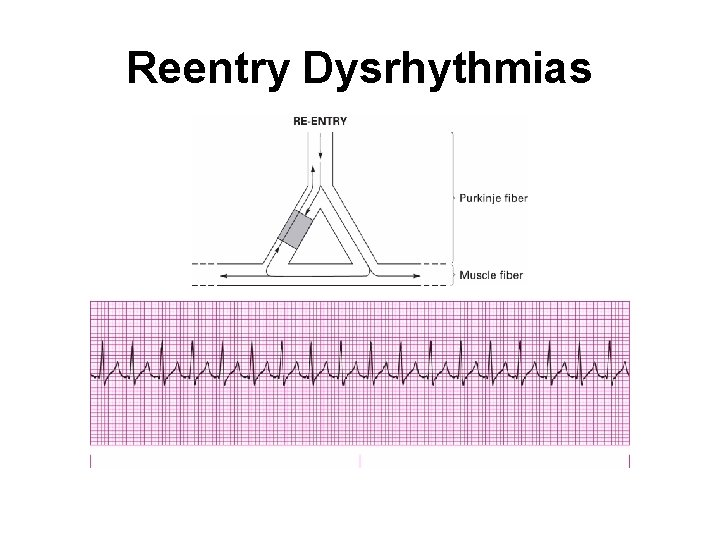 Reentry Dysrhythmias 