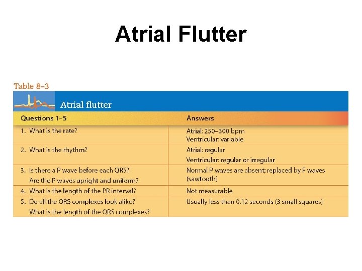 Atrial Flutter 
