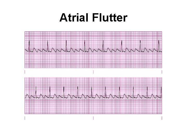 Atrial Flutter 