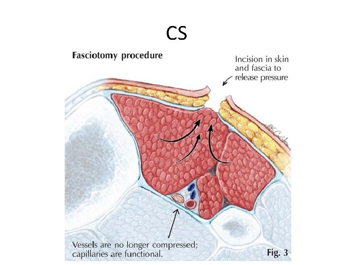 CS 