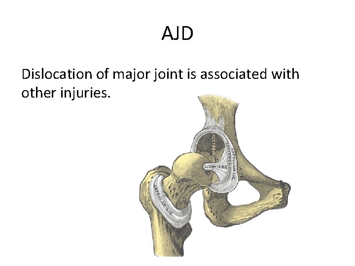 AJD Dislocation of major joint is associated with other injuries. 