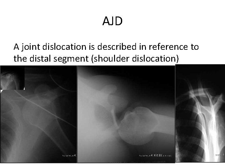AJD A joint dislocation is described in reference to the distal segment (shoulder dislocation)