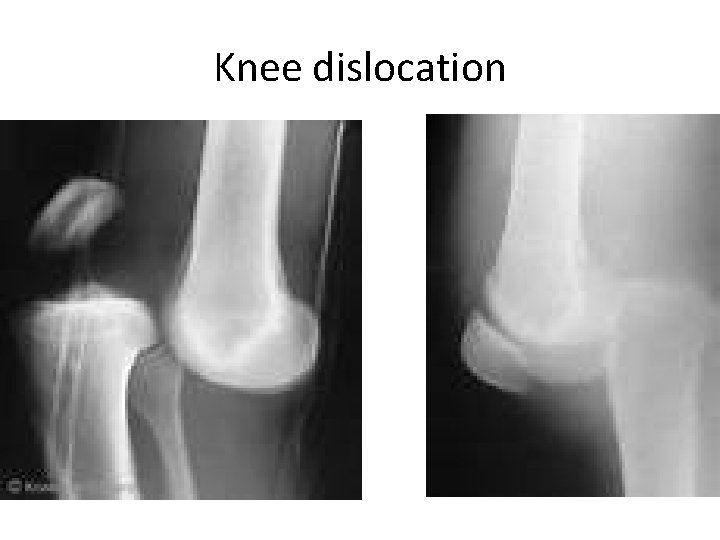 Knee dislocation 