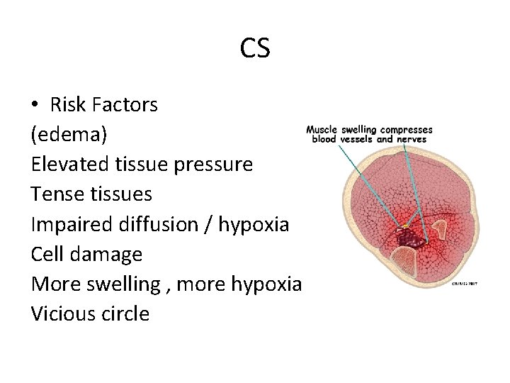 CS • Risk Factors (edema) Elevated tissue pressure Tense tissues Impaired diffusion / hypoxia