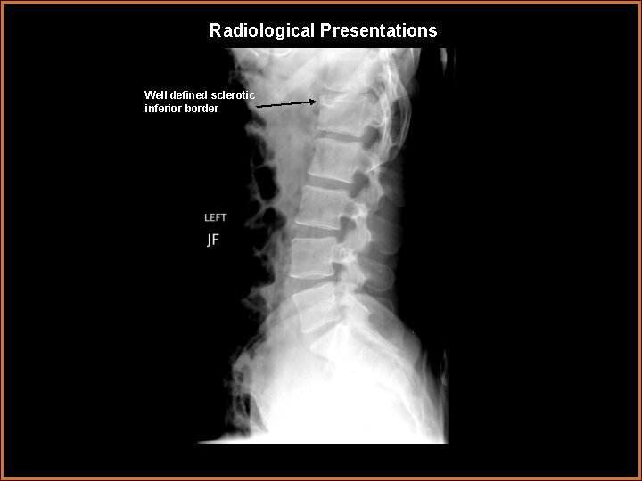 Radiological Presentations Well defined sclerotic inferior border 