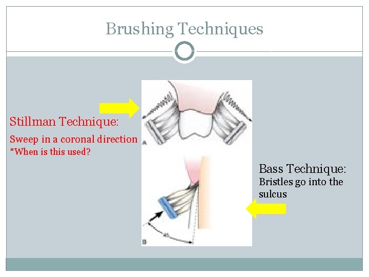 Brushing Techniques Stillman Technique: Sweep in a coronal direction *When is this used? Bass