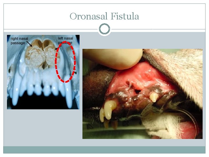 Oronasal Fistula 