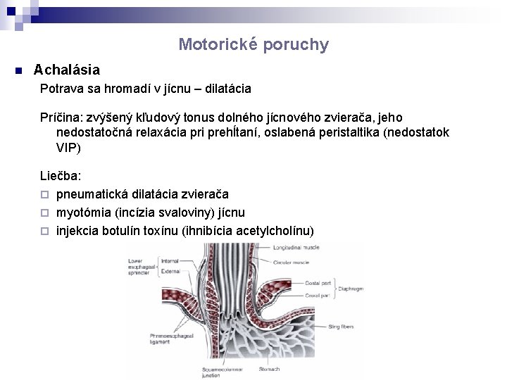 Motorické poruchy n Achalásia Potrava sa hromadí v jícnu – dilatácia Príčina: zvýšený kľudový