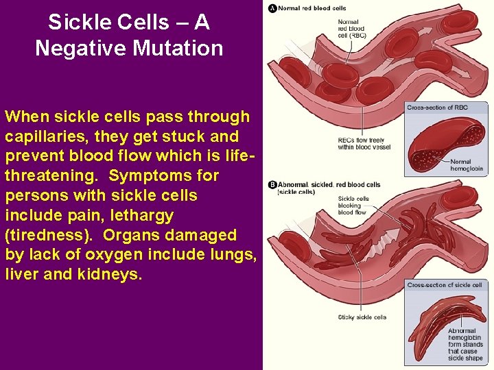 Sickle Cells – A Negative Mutation When sickle cells pass through capillaries, they get