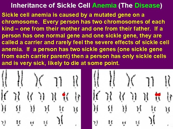 Inheritance of Sickle Cell Anemia (The Disease) Sickle cell anemia is caused by a