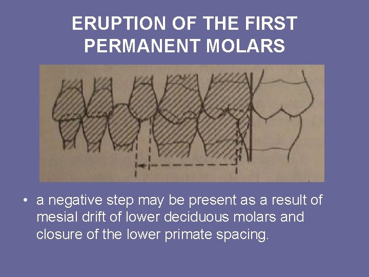 ERUPTION OF THE FIRST PERMANENT MOLARS • a negative step may be present as ERUPTION OF THE FIRST PERMANENT MOLARS • a negative step may be present as