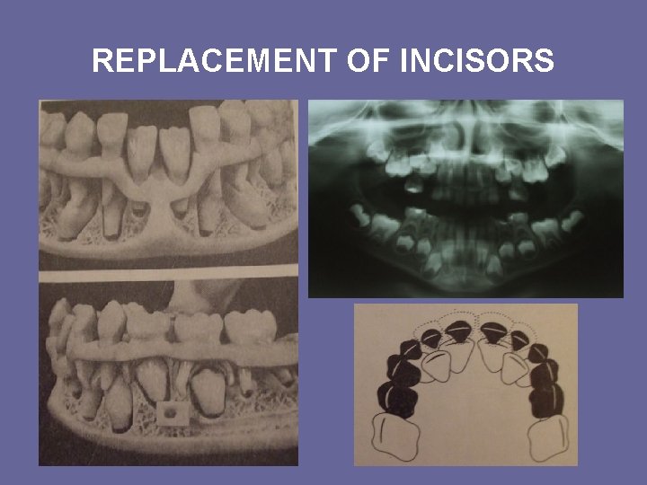 REPLACEMENT OF INCISORS REPLACEMENT OF INCISORS