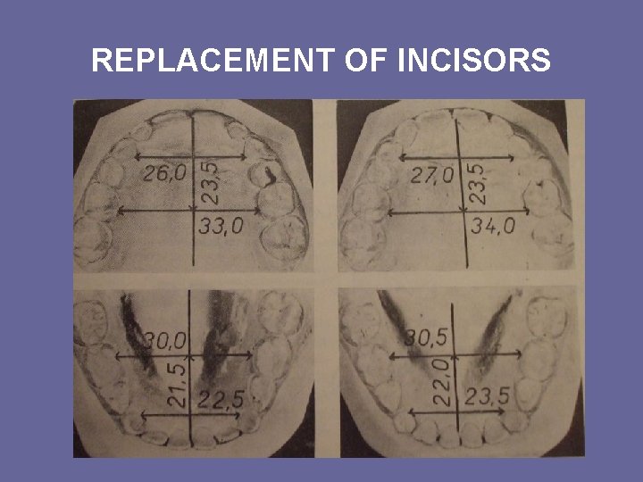 REPLACEMENT OF INCISORS REPLACEMENT OF INCISORS