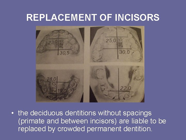 REPLACEMENT OF INCISORS • the deciduous dentitions without spacings (primate and between incisors) are REPLACEMENT OF INCISORS • the deciduous dentitions without spacings (primate and between incisors) are