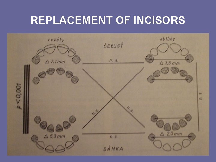 REPLACEMENT OF INCISORS REPLACEMENT OF INCISORS