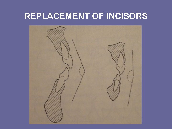 REPLACEMENT OF INCISORS REPLACEMENT OF INCISORS