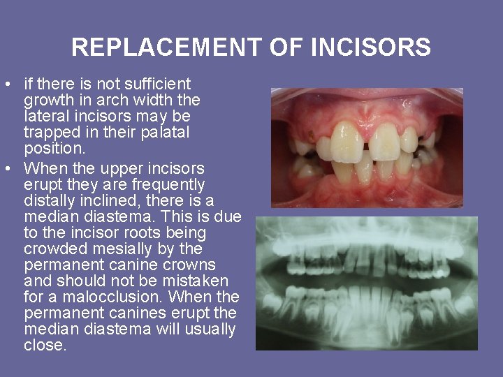 REPLACEMENT OF INCISORS • if there is not sufficient growth in arch width the REPLACEMENT OF INCISORS • if there is not sufficient growth in arch width the