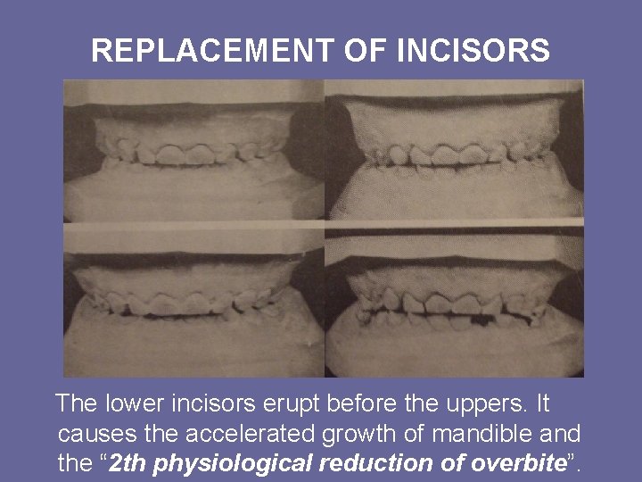 REPLACEMENT OF INCISORS The lower incisors erupt before the uppers. It causes the accelerated REPLACEMENT OF INCISORS The lower incisors erupt before the uppers. It causes the accelerated