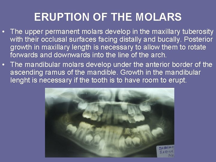 ERUPTION OF THE MOLARS • The upper permanent molars develop in the maxillary tuberosity ERUPTION OF THE MOLARS • The upper permanent molars develop in the maxillary tuberosity