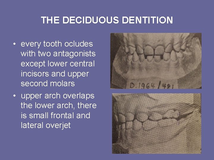 THE DECIDUOUS DENTITION • every tooth ocludes with two antagonists except lower central incisors THE DECIDUOUS DENTITION • every tooth ocludes with two antagonists except lower central incisors
