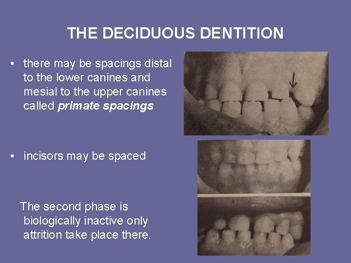 THE DECIDUOUS DENTITION • there may be spacings distal to the lower canines and THE DECIDUOUS DENTITION • there may be spacings distal to the lower canines and