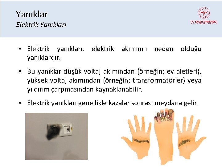 Yanıklar Elektrik Yanıkları • Elektrik yanıkları, elektrik akımının neden olduğu yanıklardır. • Bu yanıklar