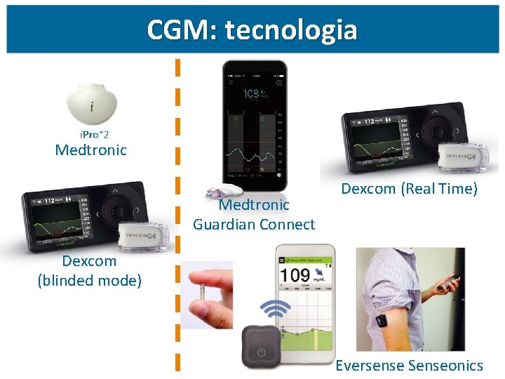 CGM: tecnologia Medtronic Guardian Connect Dexcom (Real Time) Dexcom (blinded mode) Eversense Senseonics 