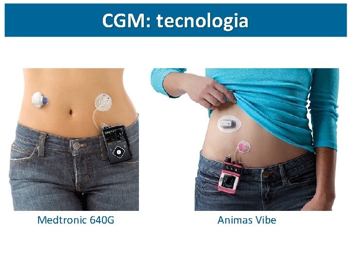 CGM: tecnologia Medtronic 640 G Animas Vibe 